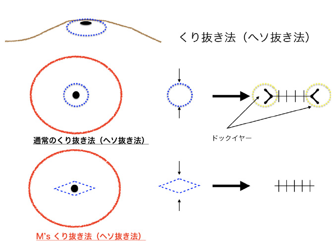 くり抜き法（ヘソ抜き法）