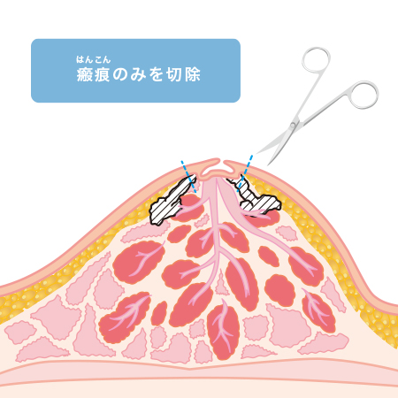 瘢痕のみを切除