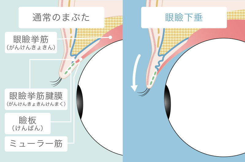 眼瞼下垂の状態