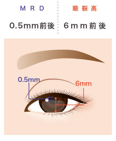 中等度下垂