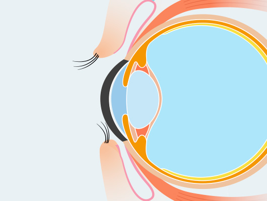 眼瞼内反症の特徴