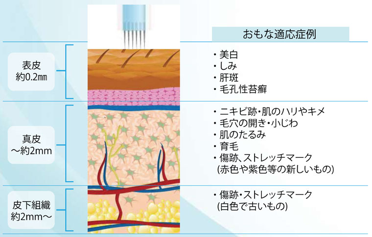 ダーマペンによる治療の適応