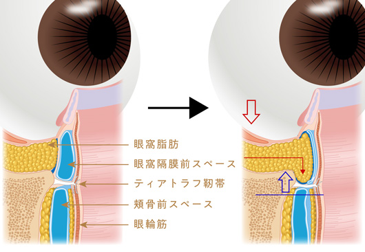 眼窩脂肪の移動イメージ