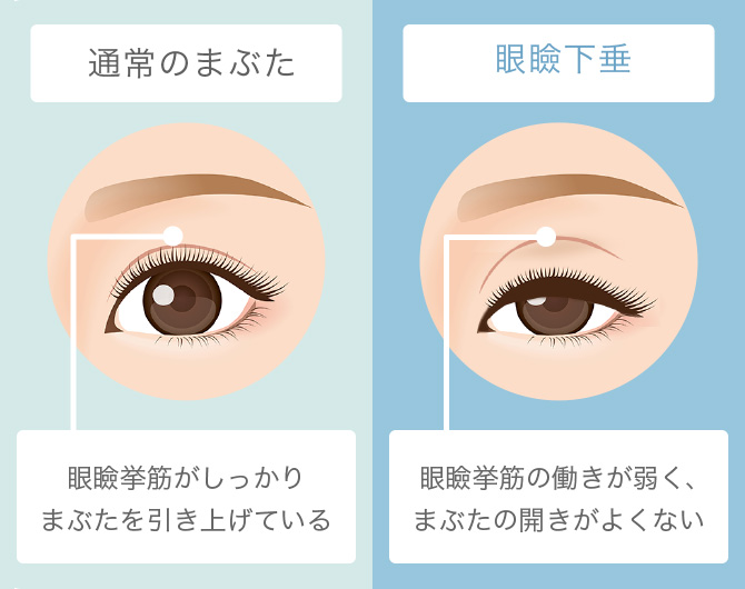 通常のまぶた・眼瞼下垂の比較