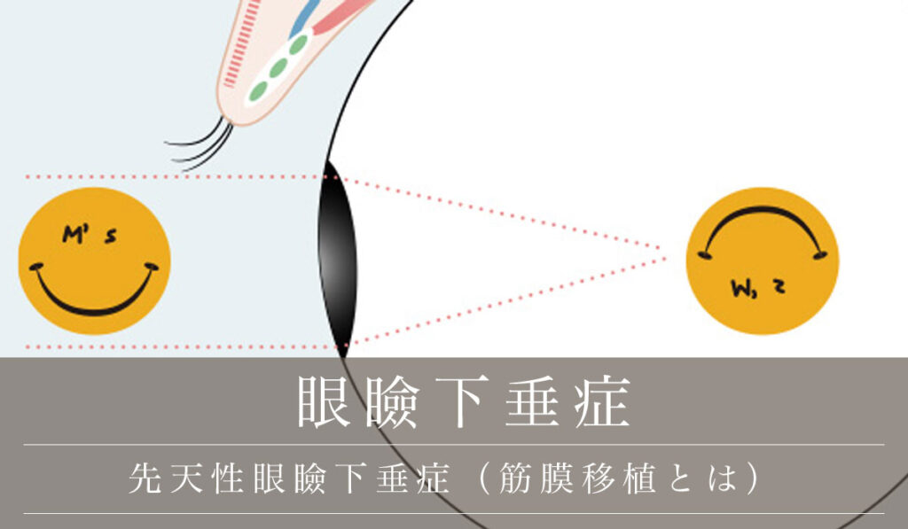 先天性眼瞼下垂症（筋膜移植とは）