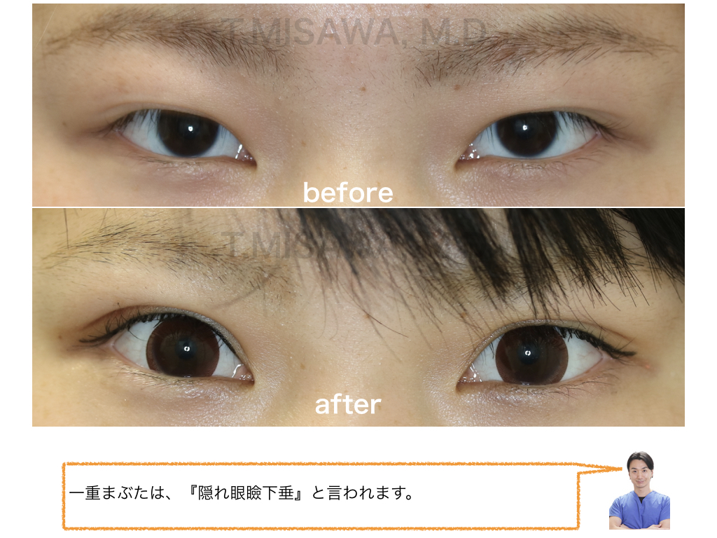 隠れ眼瞼下垂 二重 切開法 横浜市鶴見の形成 美容外科 エムズクリニック