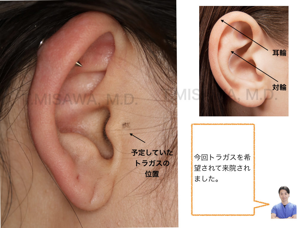 折れ耳 耳垂裂 横浜市鶴見の形成 美容外科 エムズクリニック