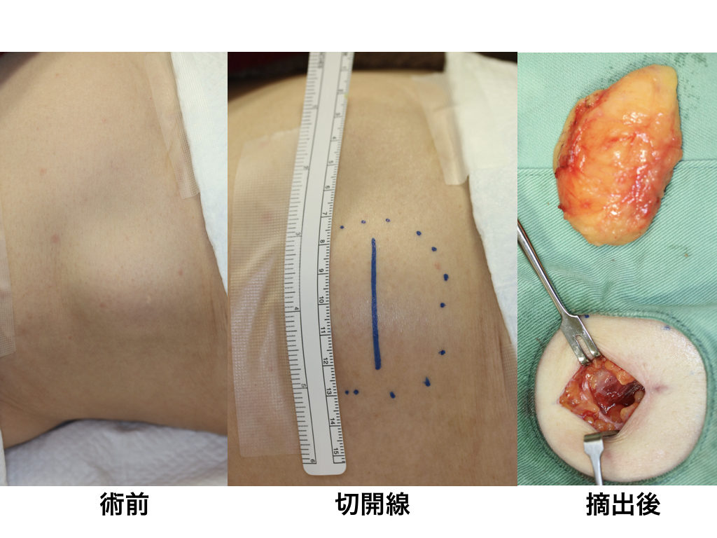 脂肪腫 横浜 Jr鶴見駅1分 ー保険日帰り手術可能ー 横浜市鶴見の形成 美容外科 エムズクリニック