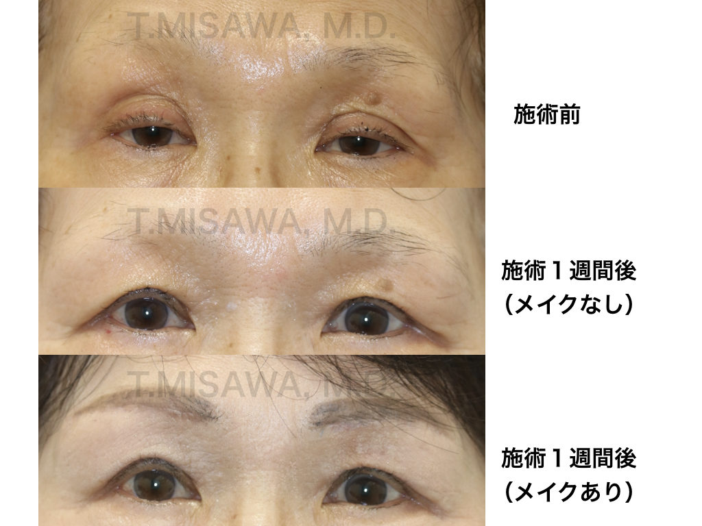 眼瞼下垂 目元アンチエイジング 横浜市鶴見の形成 美容外科 エムズクリニック