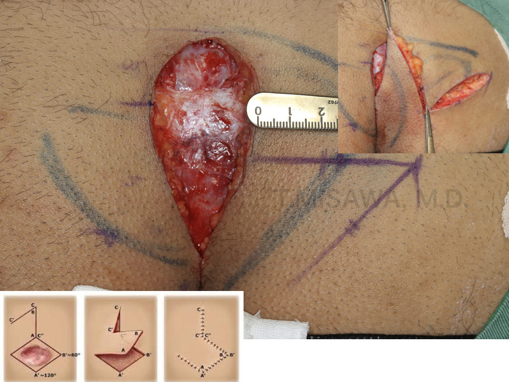 毛巣洞 横浜市鶴見の形成 美容外科 エムズクリニック