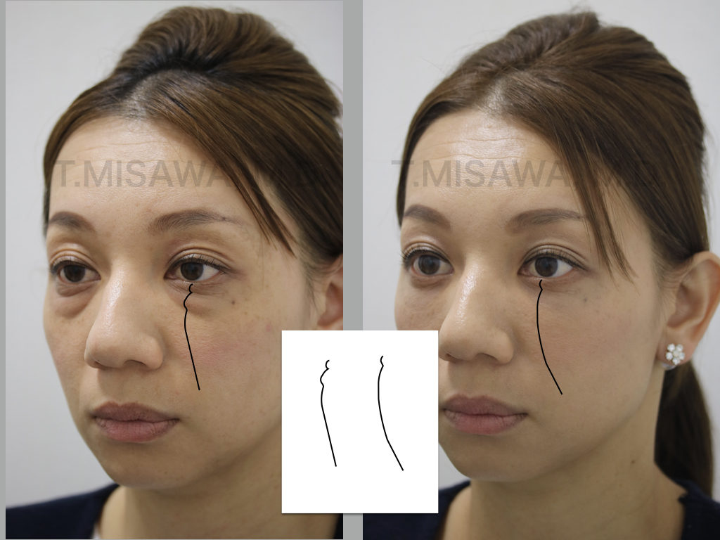 目の下のクマ治療 出クマ 透けクマ 色クマ 横浜市鶴見の形成 美容外科 エムズクリニック