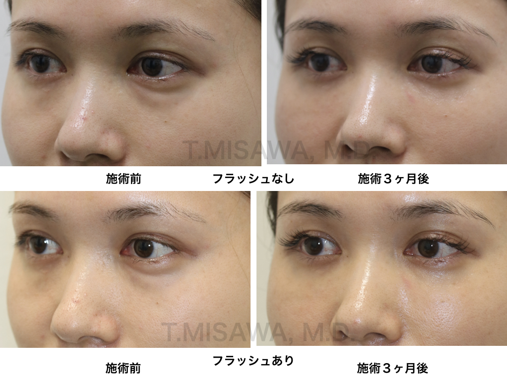 目の下のクマ治療 脱脂 脂肪注入 ピュアグラフト 部分モニター 横浜市鶴見の形成 美容外科 エムズクリニック