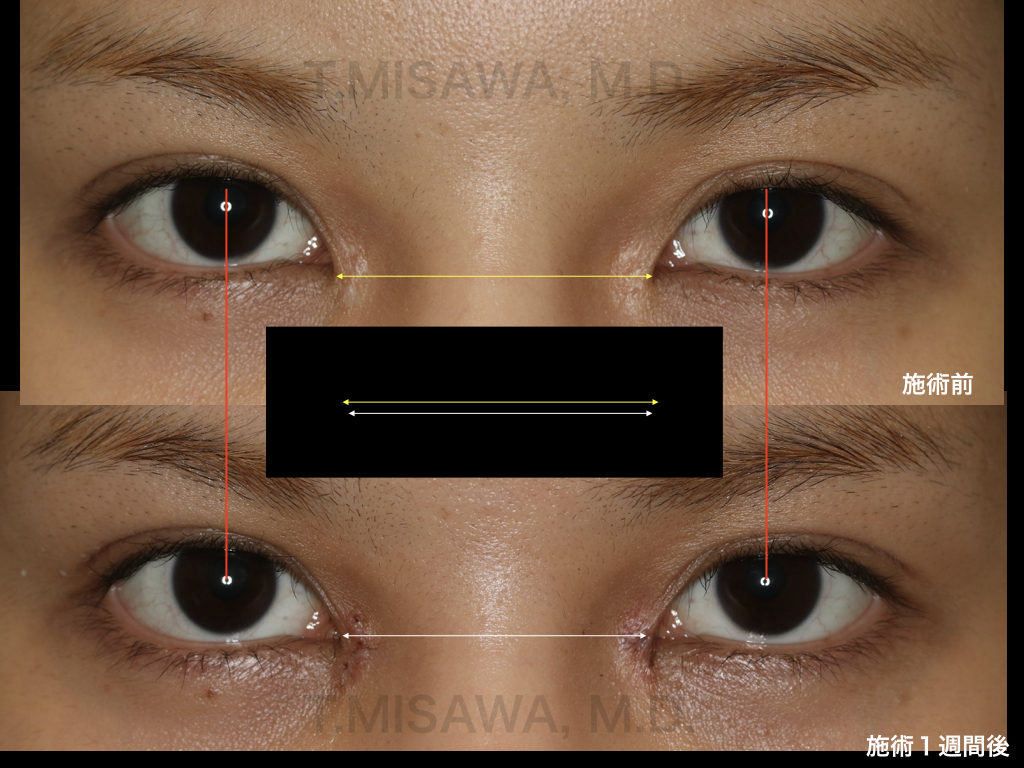 他院目頭切開後の修正 横浜市鶴見の形成 美容外科 エムズクリニック