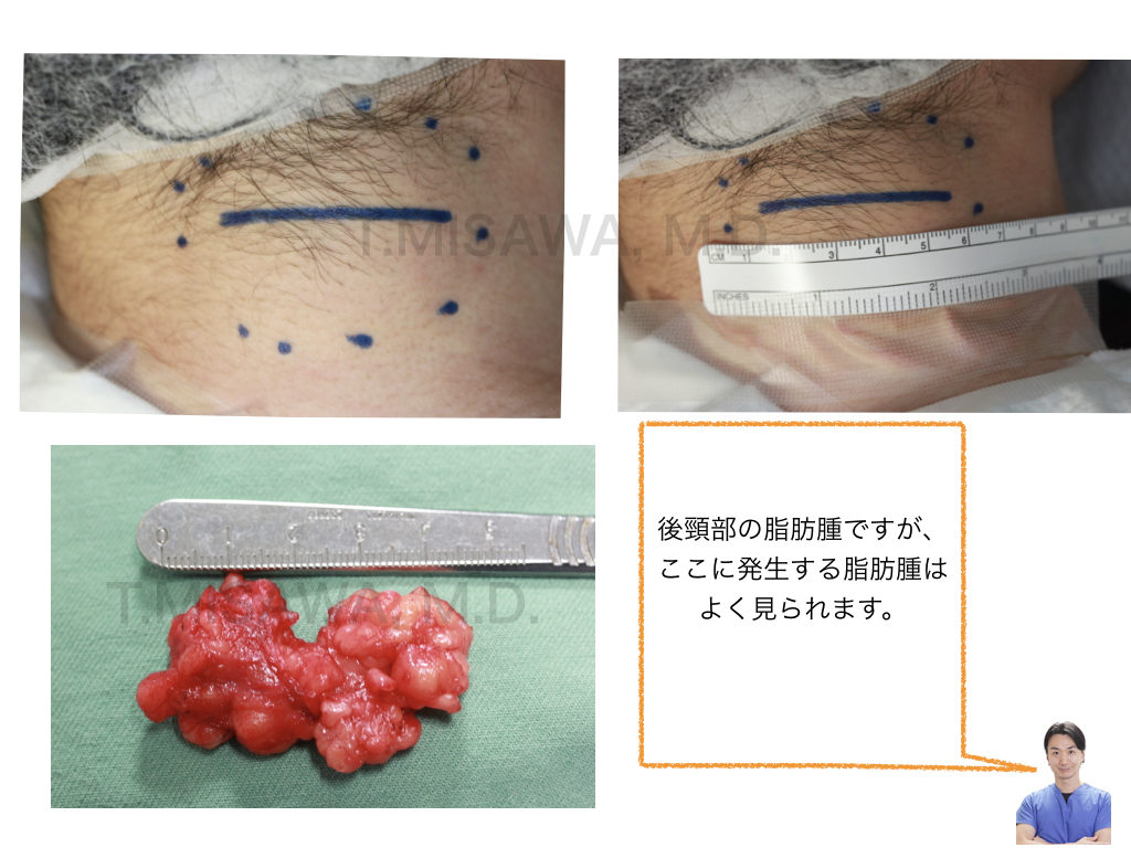 脂肪腫 横浜市鶴見の形成 美容外科 エムズクリニック