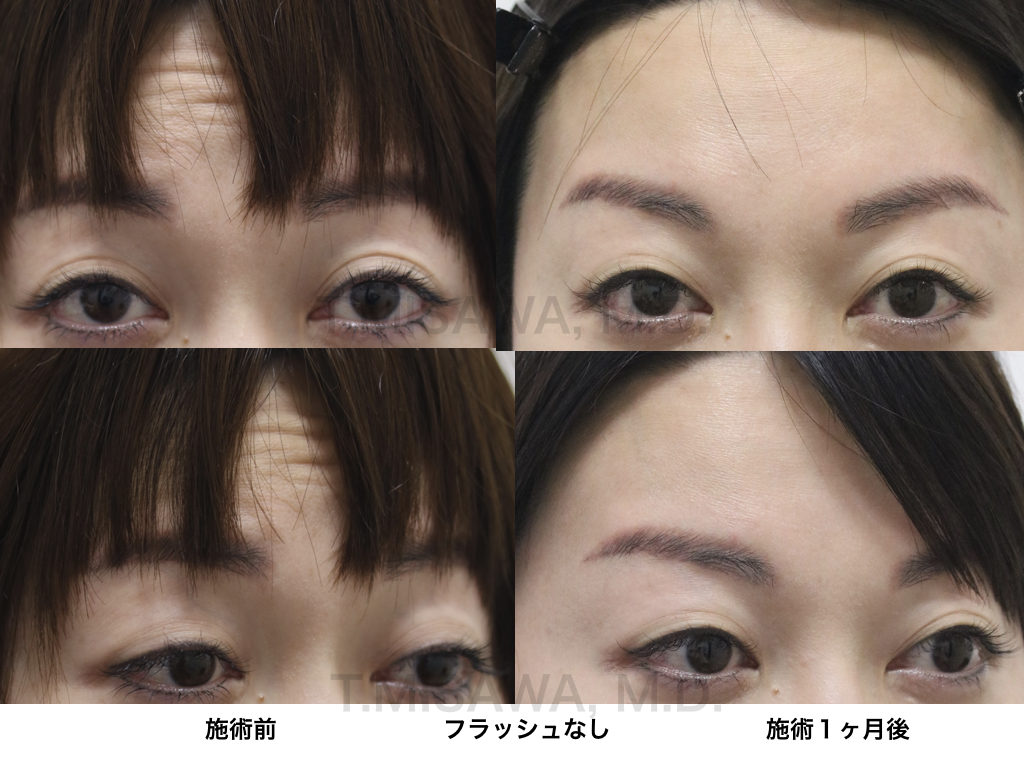 切らない眼瞼下垂 経結膜切開法 横浜市鶴見の形成 美容外科 エムズクリニック