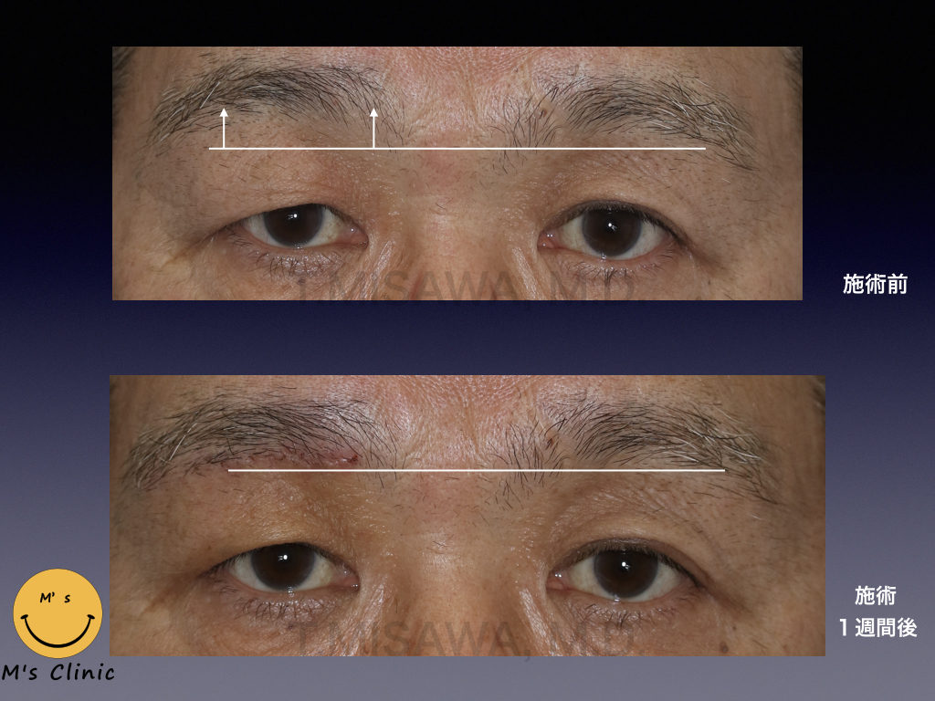 眉下皮膚切除 偽性眼瞼下垂 横浜市鶴見の形成 美容外科 エムズクリニック