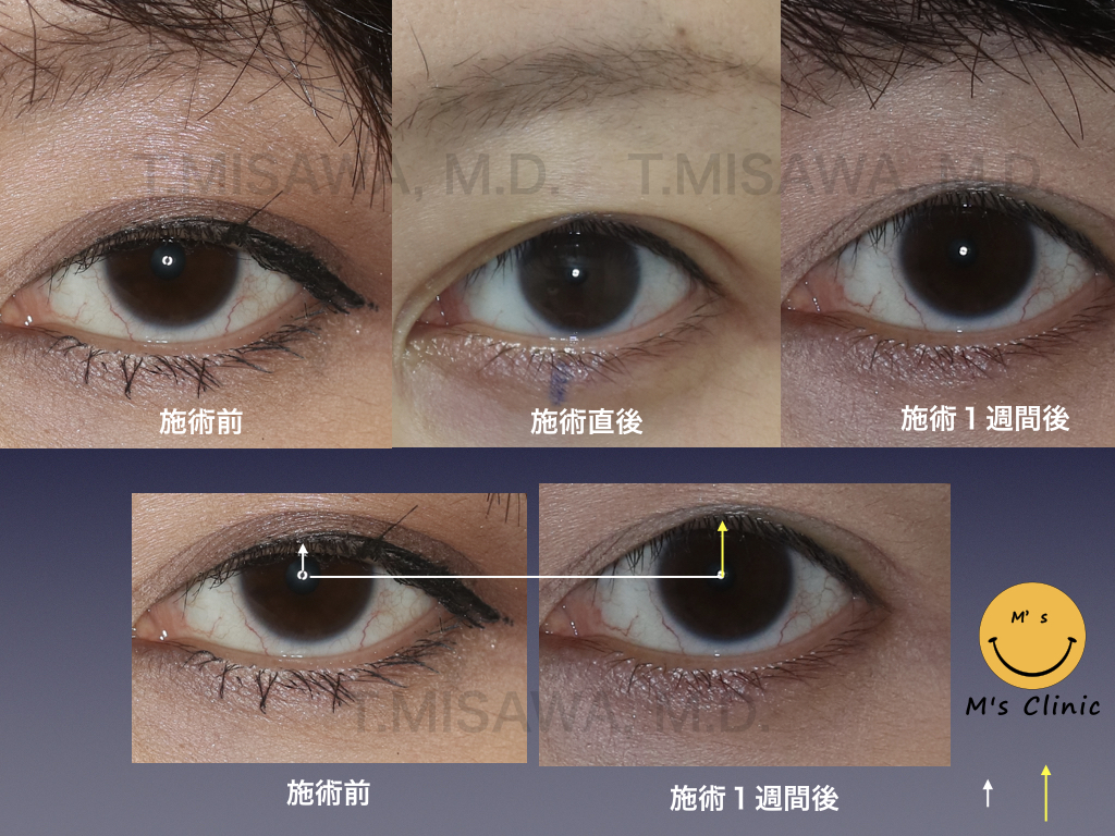 片側眼瞼下垂症 横浜市鶴見の形成 美容外科 エムズクリニック