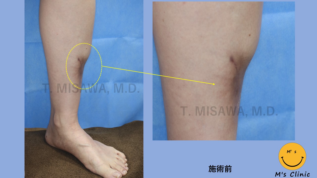 下肢 脛 すね の変形 真皮脂肪移植治療 横浜市鶴見の形成 美容外科 エムズクリニック