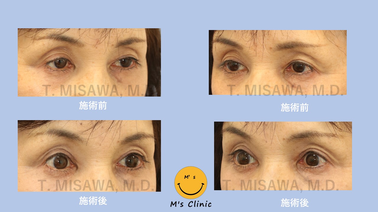 くぼみ目 腱膜性眼瞼下垂 横浜鶴見 横浜市鶴見の形成 美容外科 エムズクリニック