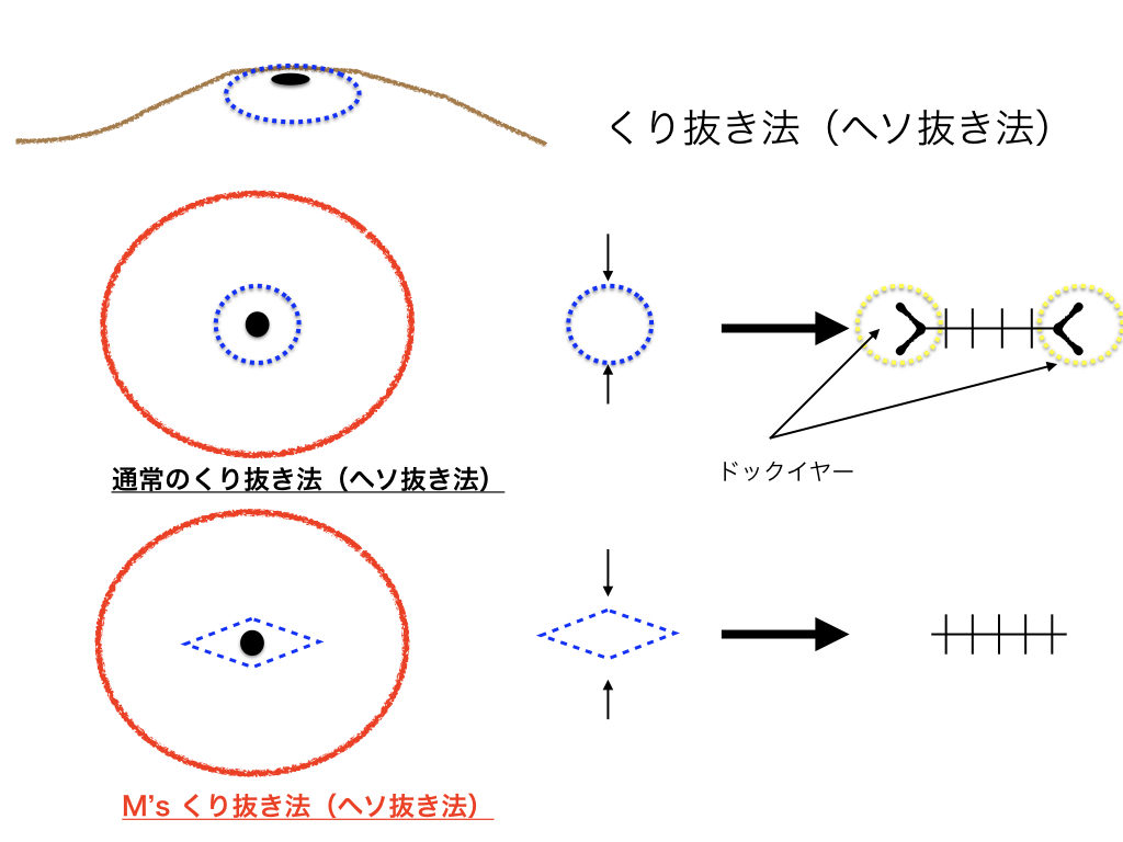粉瘤 M Sくり抜き法 症例１ 横浜 鶴見 横浜市鶴見の形成 美容外科 エムズクリニック