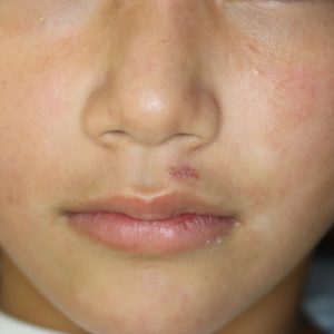 ホクロ除去 レーザーでは綺麗に取れない唇のホクロ 切開法 横浜市鶴見の形成 美容外科 エムズクリニック