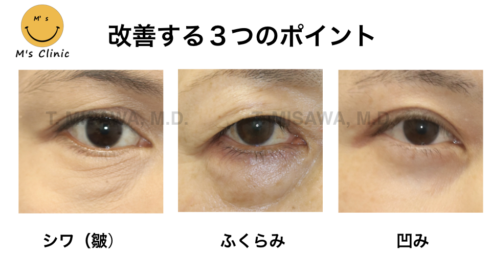 目の下のクマ たるみ治療 もっとも多い症状 目の下の膨らみ 横浜市鶴見の形成 美容外科 エムズクリニック