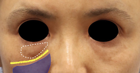中顔面の若返り 下まぶたのタルミ取り ミッドフェイスリフト 横浜市鶴見の形成 美容外科 エムズクリニック