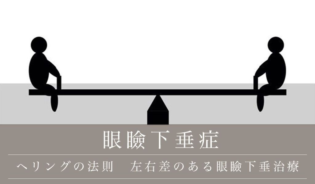 ヘリングの法則って何？ー左右差のある眼瞼下垂治療で知っておくべきこと！！ー