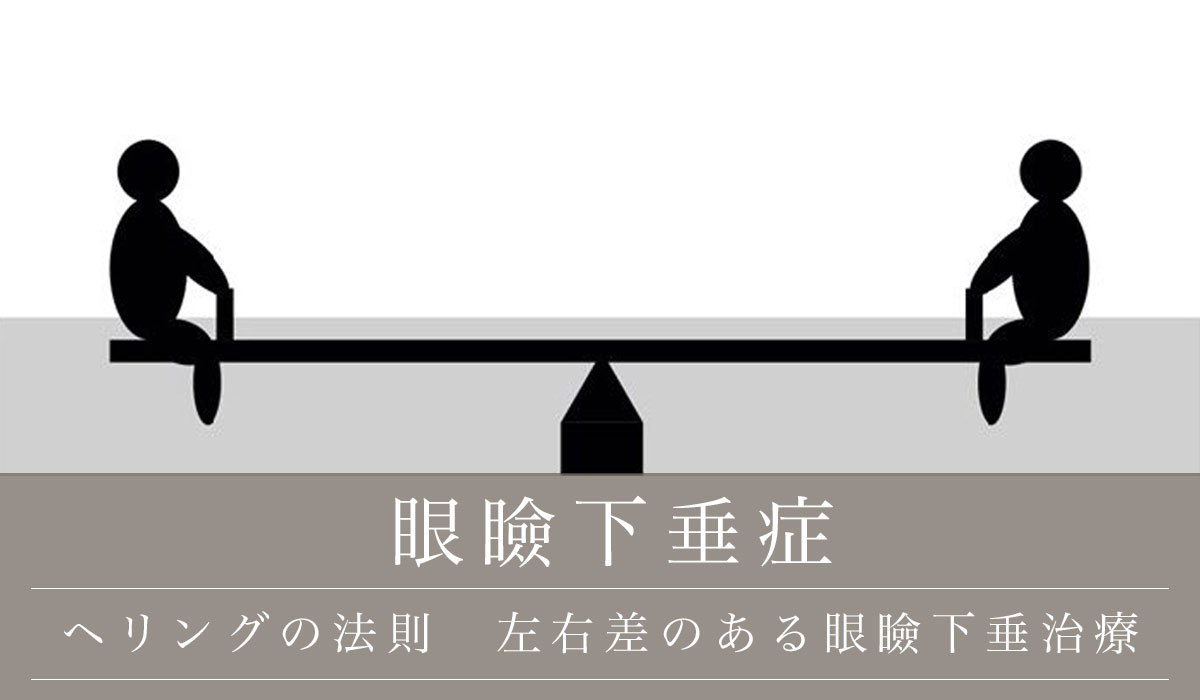 ヘリングの法則　左右差のある眼瞼下垂治療