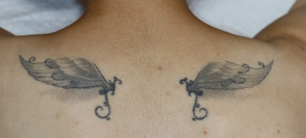 回数を少なくするためのタトゥー 刺青 除去 切除 レーザー 横浜市鶴見の形成 美容外科 エムズクリニック