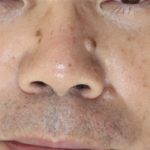 顔の【ホクロ切除】３つを同時に行いました　治療前