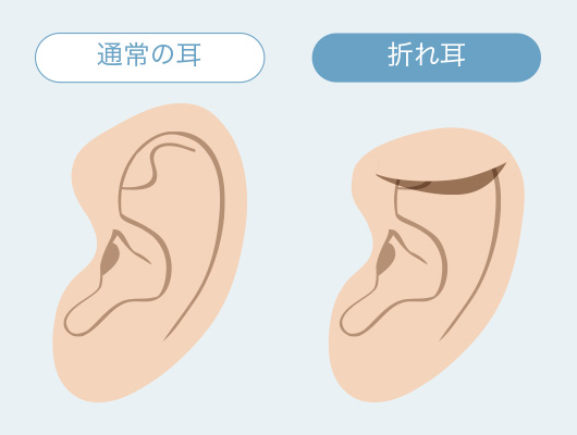 通常の耳・折れ耳の比較