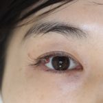 まつ毛の間にできた【ホクロ】はこうして取りました！　治療前