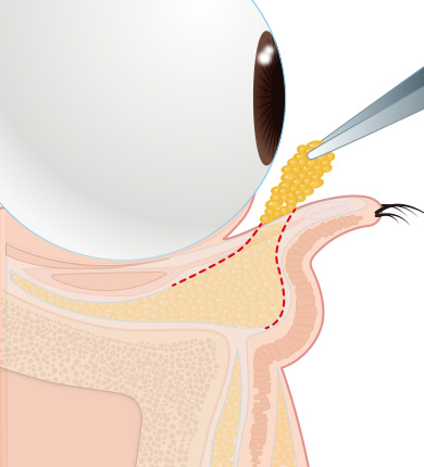 脱脂のイラスト