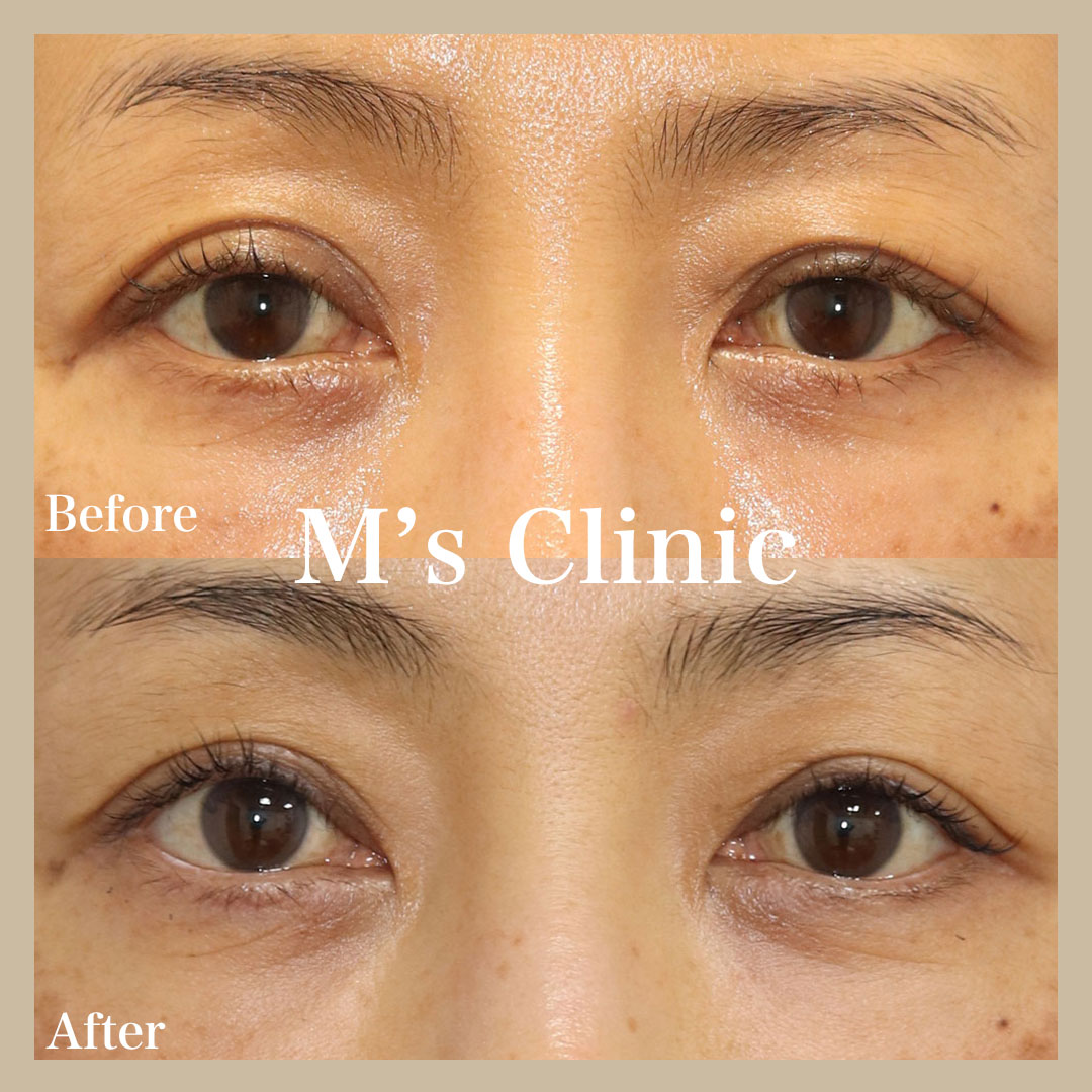 EYE eyelid surgery セレクト美容塾　眼瞼　まぶた　希少 睫毛上切開】で年齢に伴う目の上のたるみ・軽度の眼瞼下垂・二重幅の