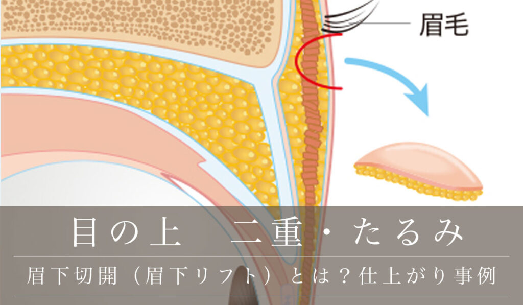 眉下切開（眉下リフト）とは？上手い手術・仕上がり事例もご紹介