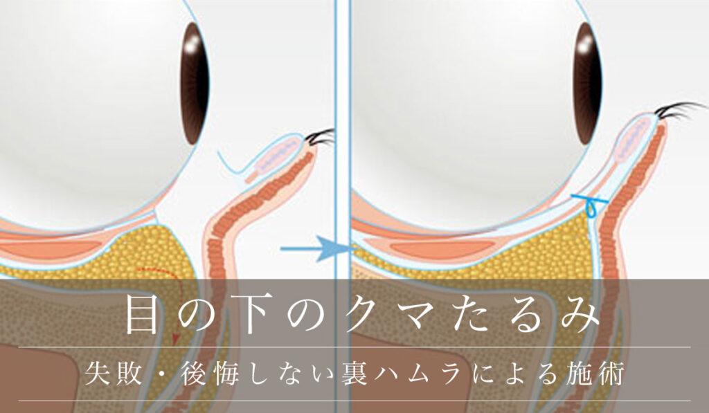 失敗・後悔しない裏ハムラ（眼窩隔膜移動術）によるダウンタイムのない施術