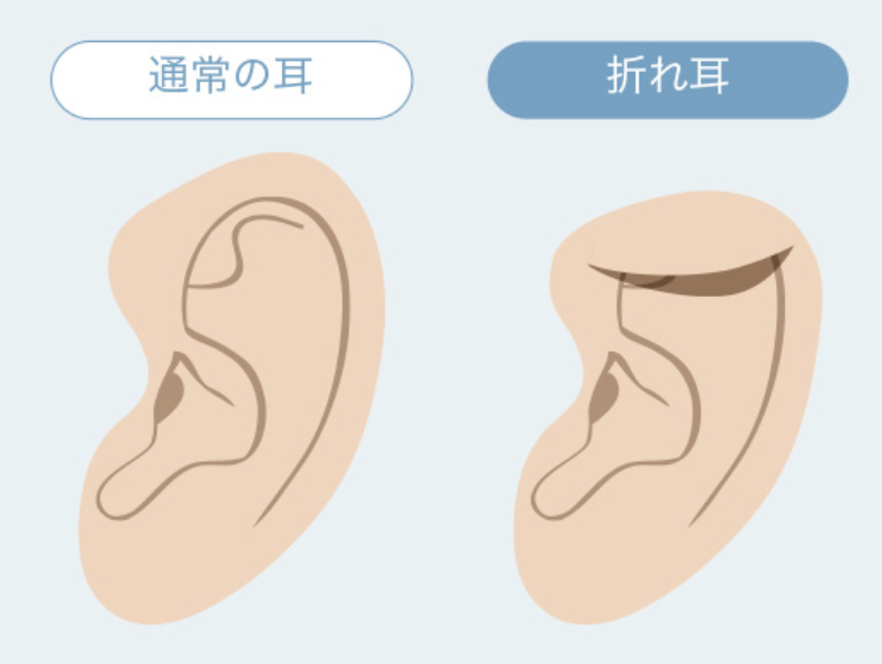 【保険適用可能】折れ耳・スタール耳の原因と治療法