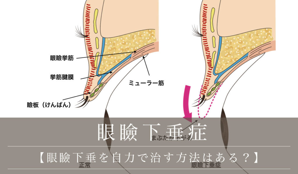 【眼瞼下垂を自力で治す方法はある？】医療用テープやセルフマッサージなどの注意点