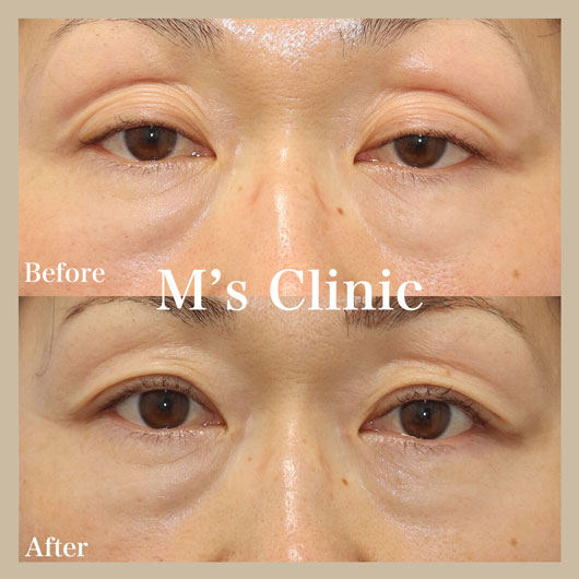 切らない眼瞼下垂ビフォアアフター