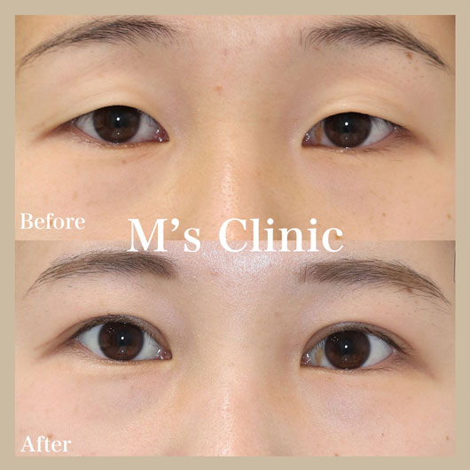 二重になった事例ビフォアアフター