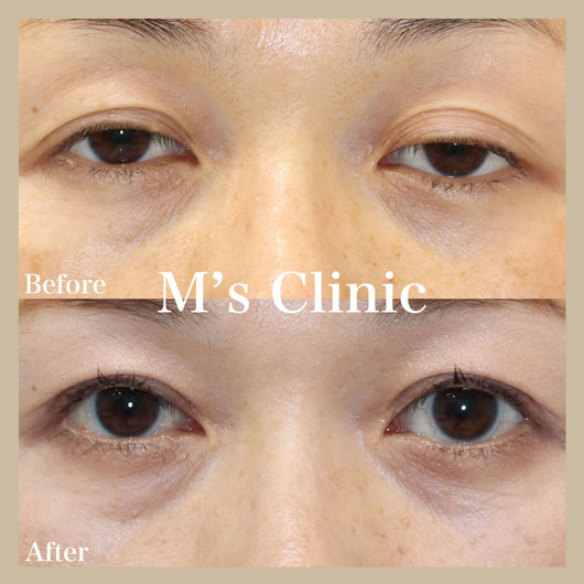 眼瞼下垂手術ビフォアアフター症例写真