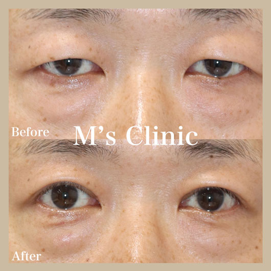 一重瞼の眼瞼下垂症例