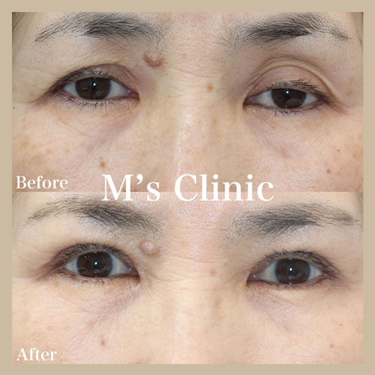 眼瞼下垂のビフォアアフター症例