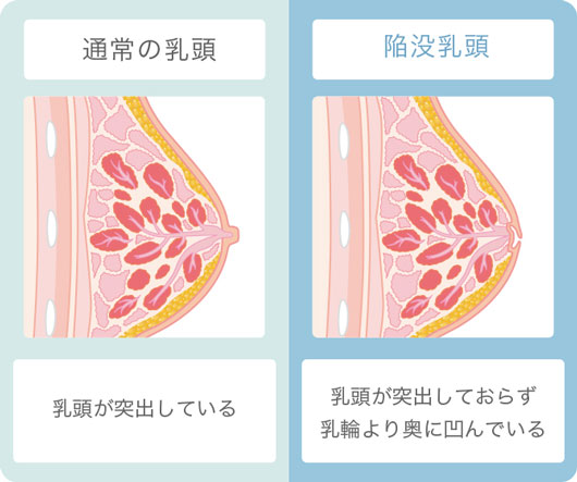 通常の乳頭と陥没乳頭の比較