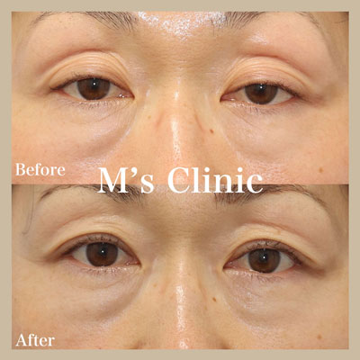 切らない眼瞼下垂ビフォアアフター