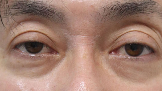 眼瞼下垂の手術前