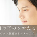 男性（メンズ）のクマ解消法とビフォアアフター事例