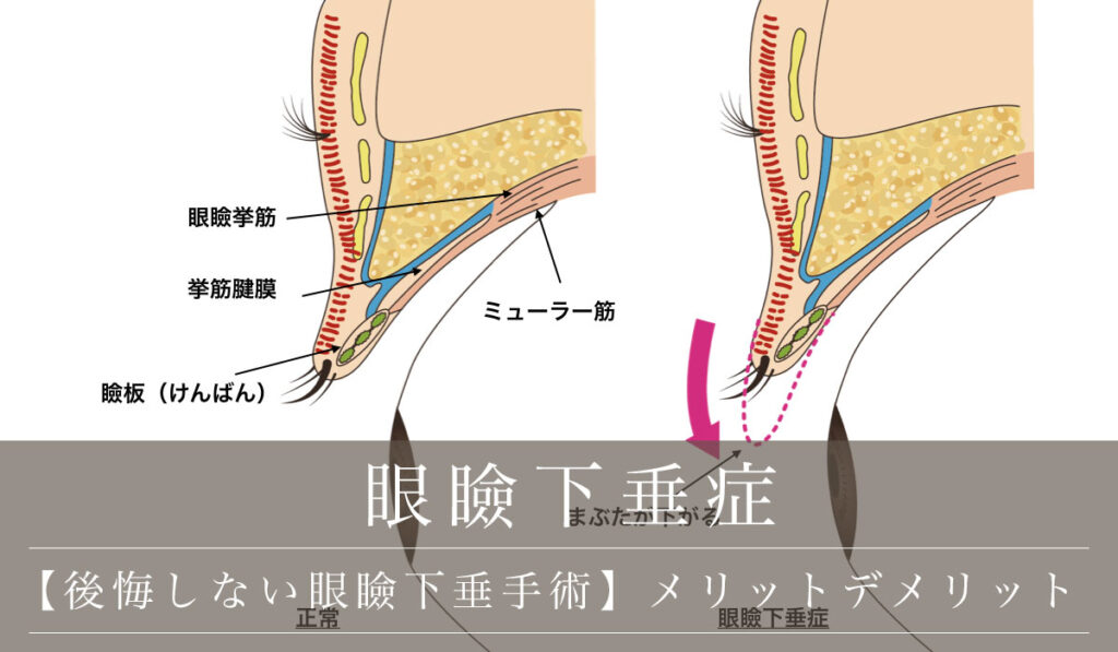 【後悔しない眼瞼下垂手術】メリットとデメリット・手術のポイント