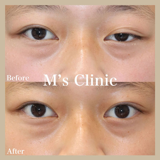 若い人（10代）の左目の眼瞼下垂症のビフォアアフター